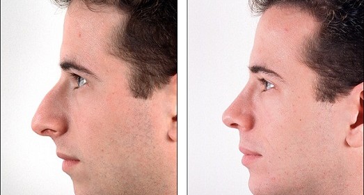 rhinoplasty-before-and-after-766-523x280
