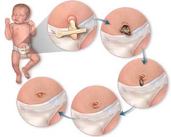 توصیه هایی درباره مراقبت از بند ناف نوزاد پس از تولد