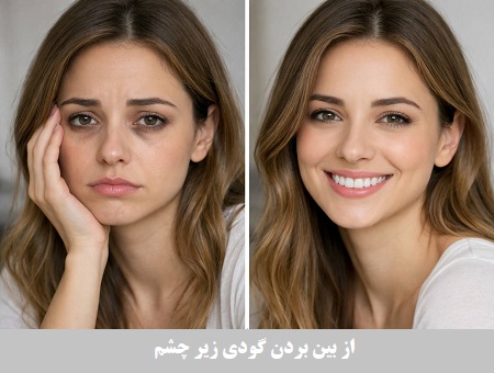 از بین بردن گودی زیر چشم از بین بردن گودی زیر چشم