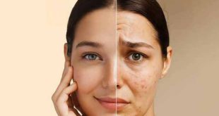 علت و راه‌های از بین بردن جای جوش قهوه‌ای