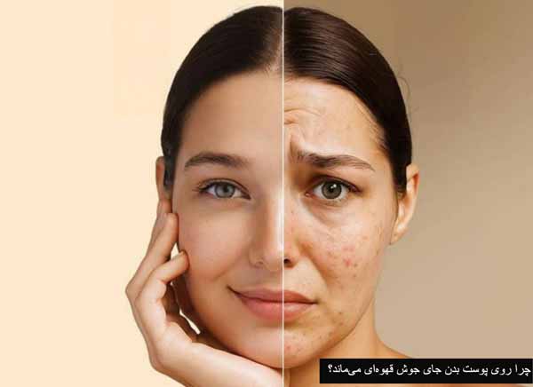 علت و راههای از بین بردن جای جوش قهوهای علت و راههای از بین بردن جای جوش قهوهای